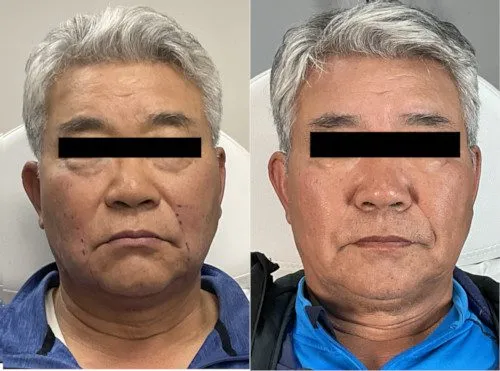 Original Agnes RF Facelift case photograph