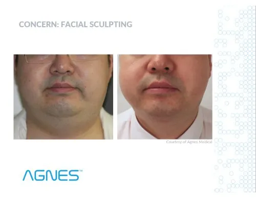 Original Agnes RF Facelift case photograph