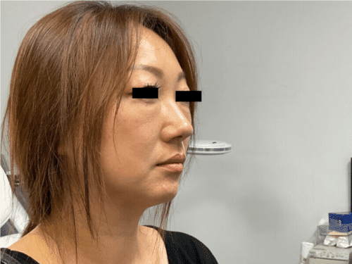 Agnes RF Facelift