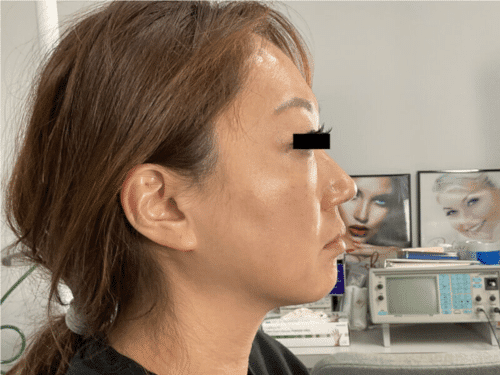 Original Agnes RF Facelift case photograph