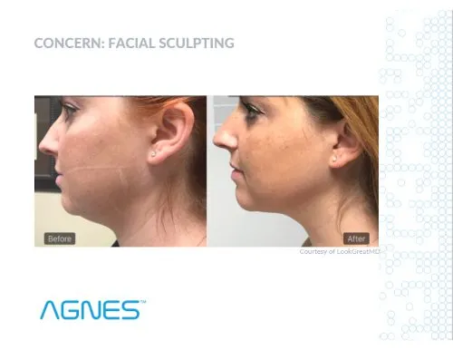 Original Agnes RF Facelift case photograph