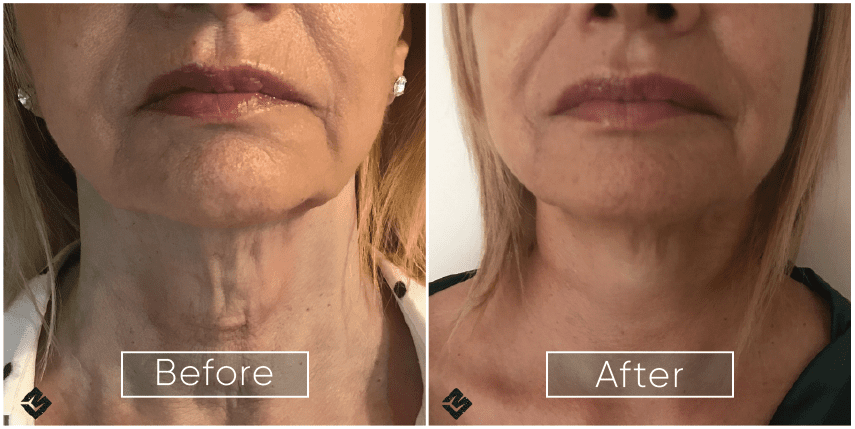 Original IPL Treatment case photograph