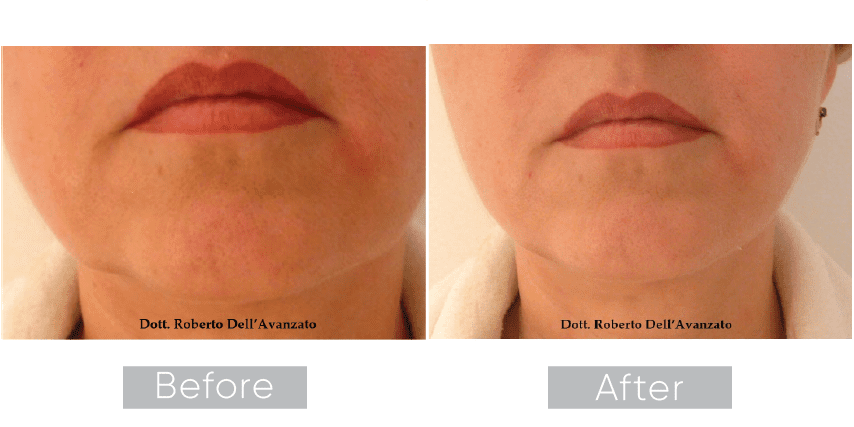 Original IPL Treatment case photograph