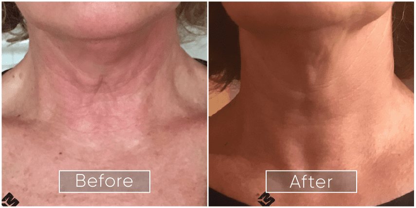 Original IPL Treatment case photograph