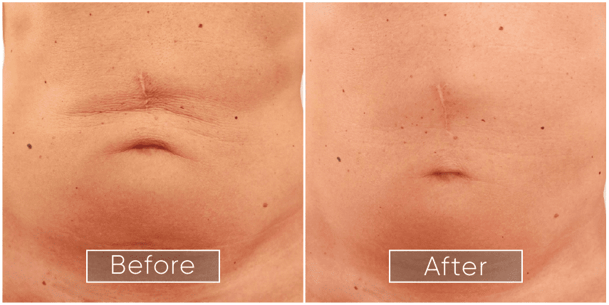 Original IPL Treatment case photograph