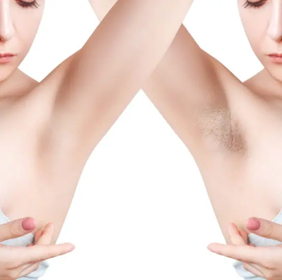 Laser Hair Removals